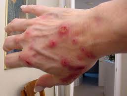 Morgellons diseased hand